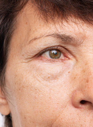 Close-up of a woman’s half face showing melasma