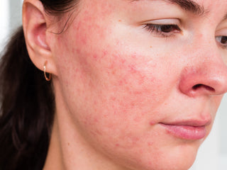 Close-up of a woman’s face showing rosacea flares and facial redness