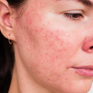 Skin barrier damage: redness, rosacea flare-up, and inflamed texture on cheek