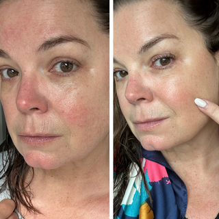 before and after rosacea