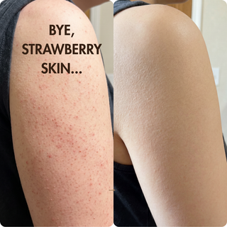 Woman before and after strawberry skin arm
