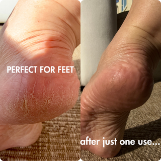 before and after of the feet heels cracking to smooth