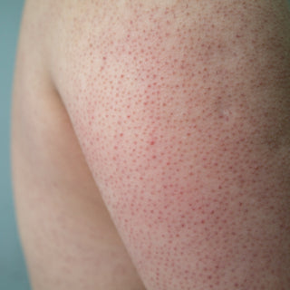 Arm/back skin with keratosis pilaris