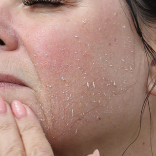 Close-up of Gommage Peeling Gel lifting dead skin cells on sensitive rosacea-prone skin — gentle exfoliation without scrubbing by Sonia Roselli Beauty