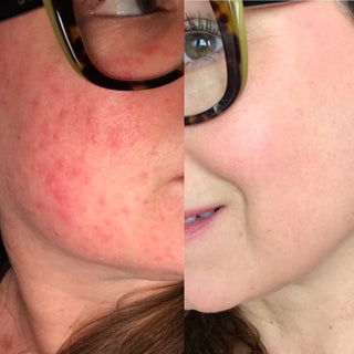 a before and after rosacea