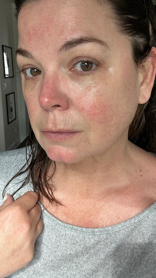 sonia roselli showing her rosacea flare